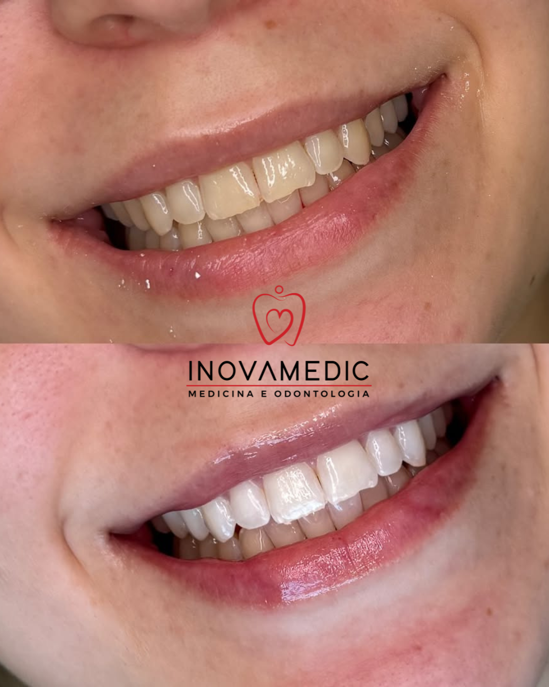 Reabilitação estética — caso C